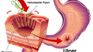 Medicii japonezi au gasit tratamentul natural pentru “HELICOBACTER PYLORI”!