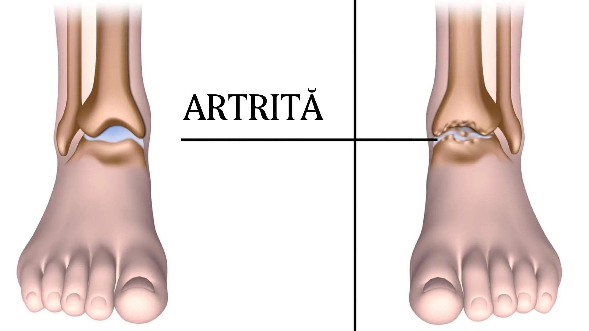 15 alimente care ajută la reducerea durerii cauzată de artrită