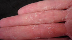 Semnele instalării cancerului în organism se observă prima dată pe mâini!