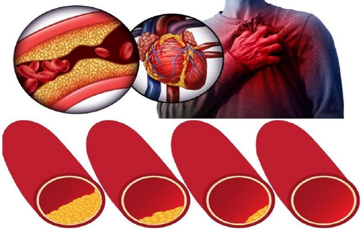 Pentru a preveni atacurile de cord, trebuie să vă curățați arterele. Iată alimentele pe care trebuie să le mănânci des pentru a face acest lucru