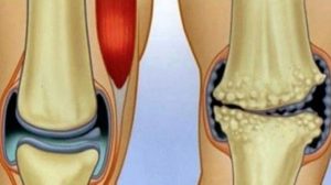 Remedii naturale anti-inflamatorii care fac minuni pentru durerile articulare și de genunchi